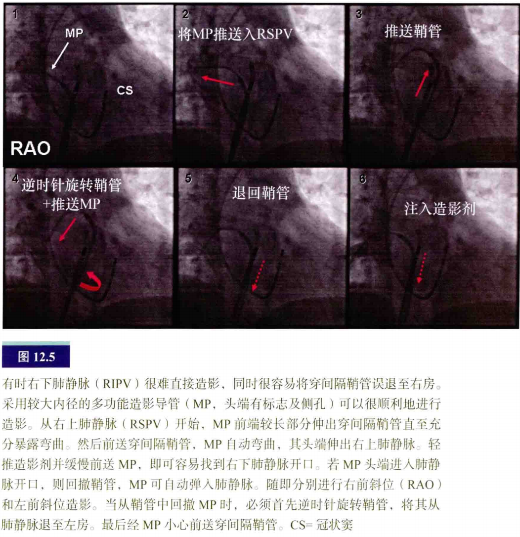 介入怎么进导管介入秘籍：心脏导管操作技巧_https://www.jmylbn.com_新闻资讯_第6张