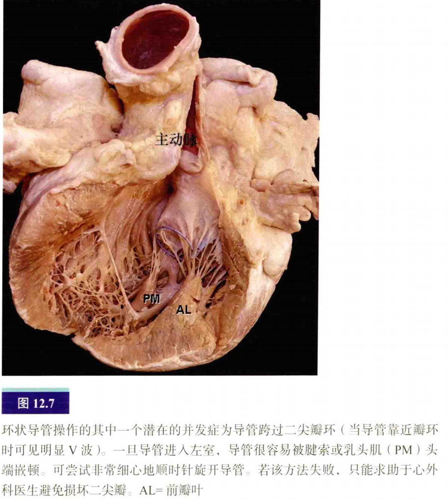 介入怎么进导管介入秘籍：心脏导管操作技巧_https://www.jmylbn.com_新闻资讯_第8张
