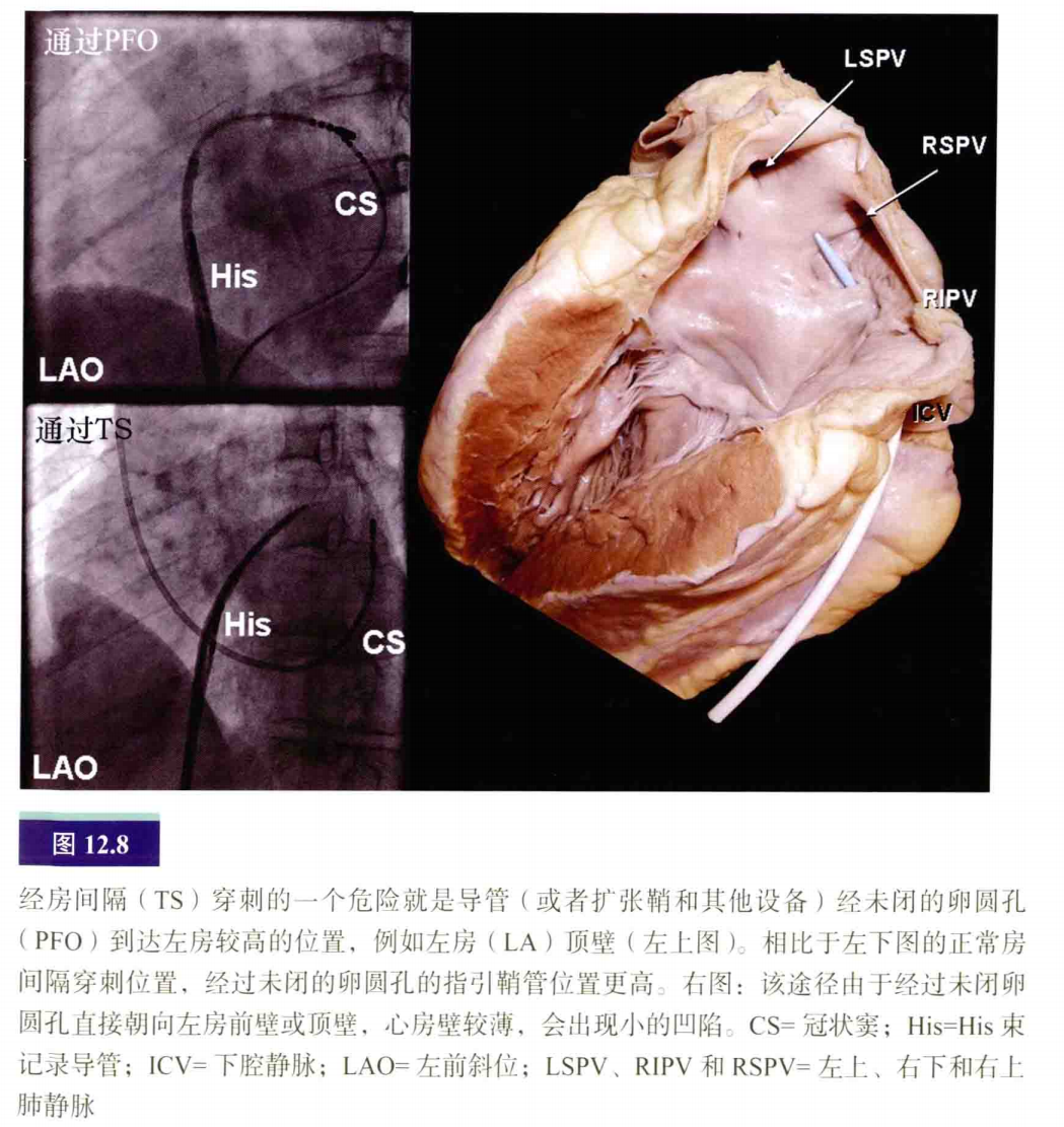 介入怎么进导管介入秘籍：心脏导管操作技巧_https://www.jmylbn.com_新闻资讯_第9张