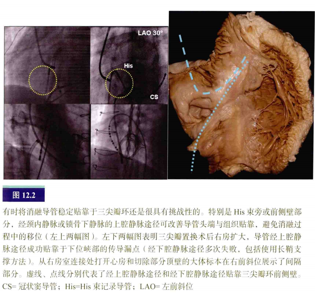介入怎么进导管介入秘籍：心脏导管操作技巧_https://www.jmylbn.com_新闻资讯_第3张