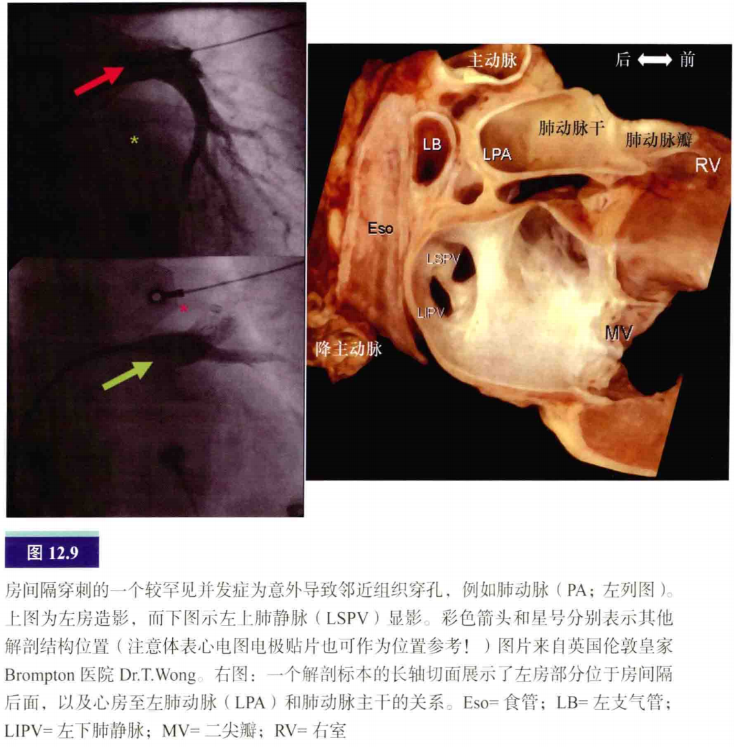 介入怎么进导管介入秘籍：心脏导管操作技巧_https://www.jmylbn.com_新闻资讯_第10张