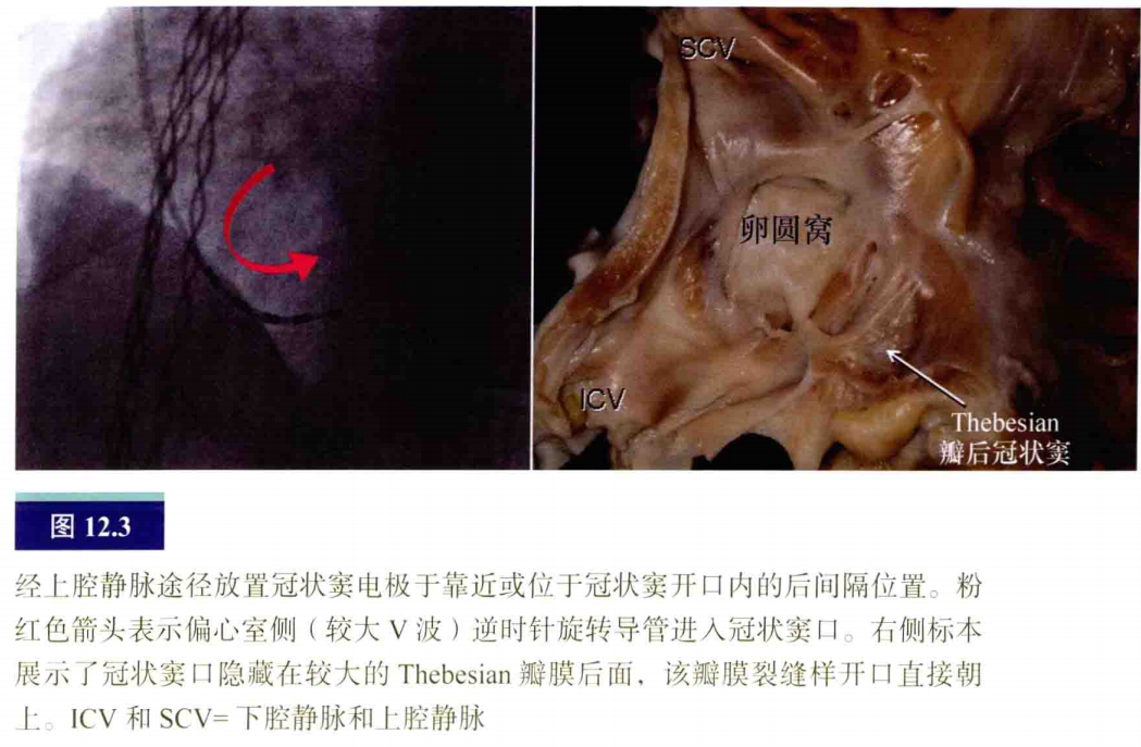 介入怎么进导管介入秘籍：心脏导管操作技巧_https://www.jmylbn.com_新闻资讯_第4张