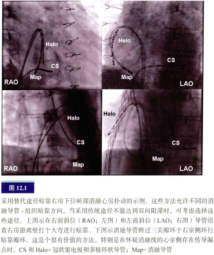 介入怎么进导管介入秘籍：心脏导管操作技巧_https://www.jmylbn.com_新闻资讯_第2张