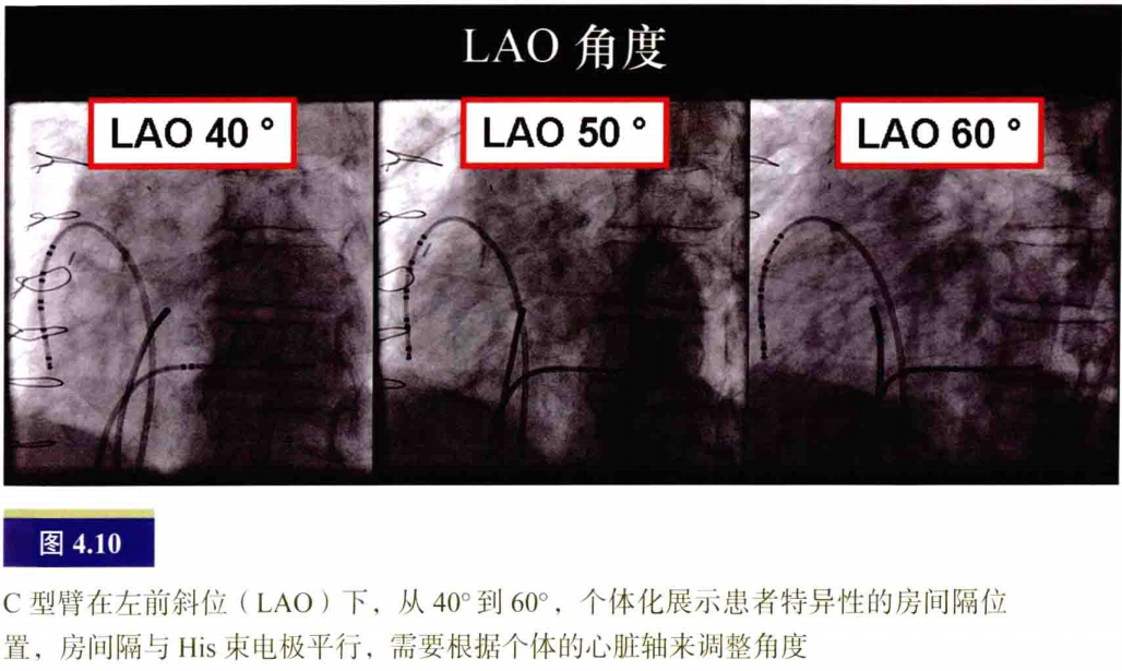 什么是电生理导管常规导管的放置：电生理和解剖_https://www.jmylbn.com_新闻资讯_第10张