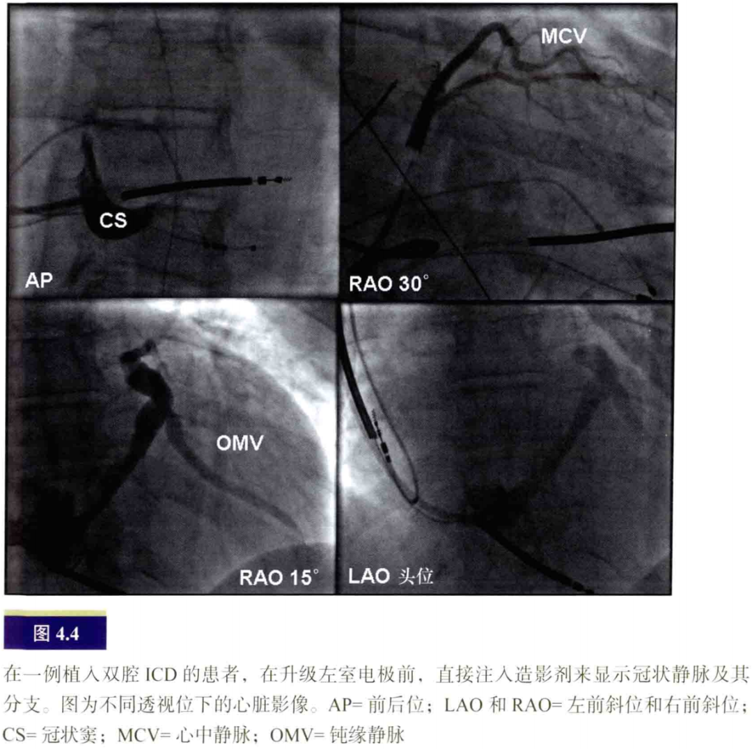 什么是电生理导管常规导管的放置：电生理和解剖_https://www.jmylbn.com_新闻资讯_第4张