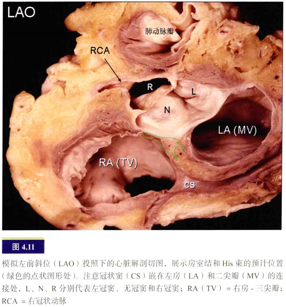 什么是电生理导管常规导管的放置：电生理和解剖_https://www.jmylbn.com_新闻资讯_第11张