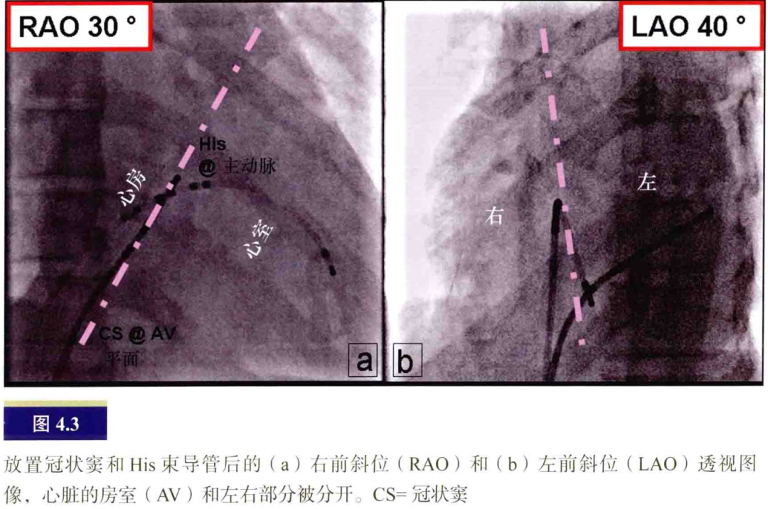 什么是电生理导管常规导管的放置：电生理和解剖_https://www.jmylbn.com_新闻资讯_第3张