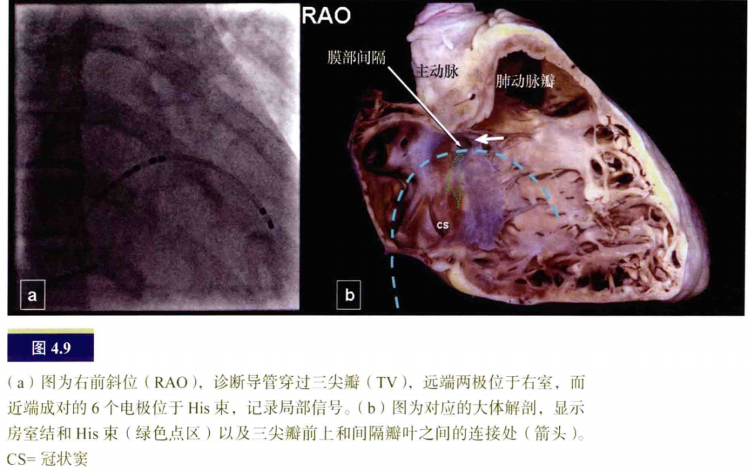 什么是电生理导管常规导管的放置：电生理和解剖_https://www.jmylbn.com_新闻资讯_第9张
