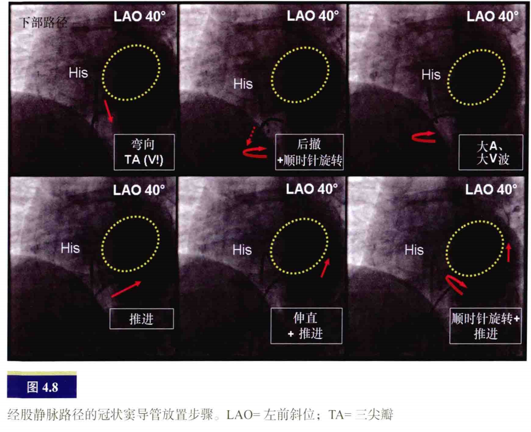 什么是电生理导管常规导管的放置：电生理和解剖_https://www.jmylbn.com_新闻资讯_第8张