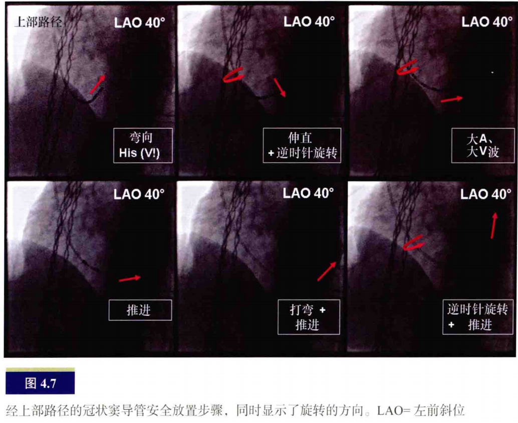 什么是电生理导管常规导管的放置：电生理和解剖_https://www.jmylbn.com_新闻资讯_第7张