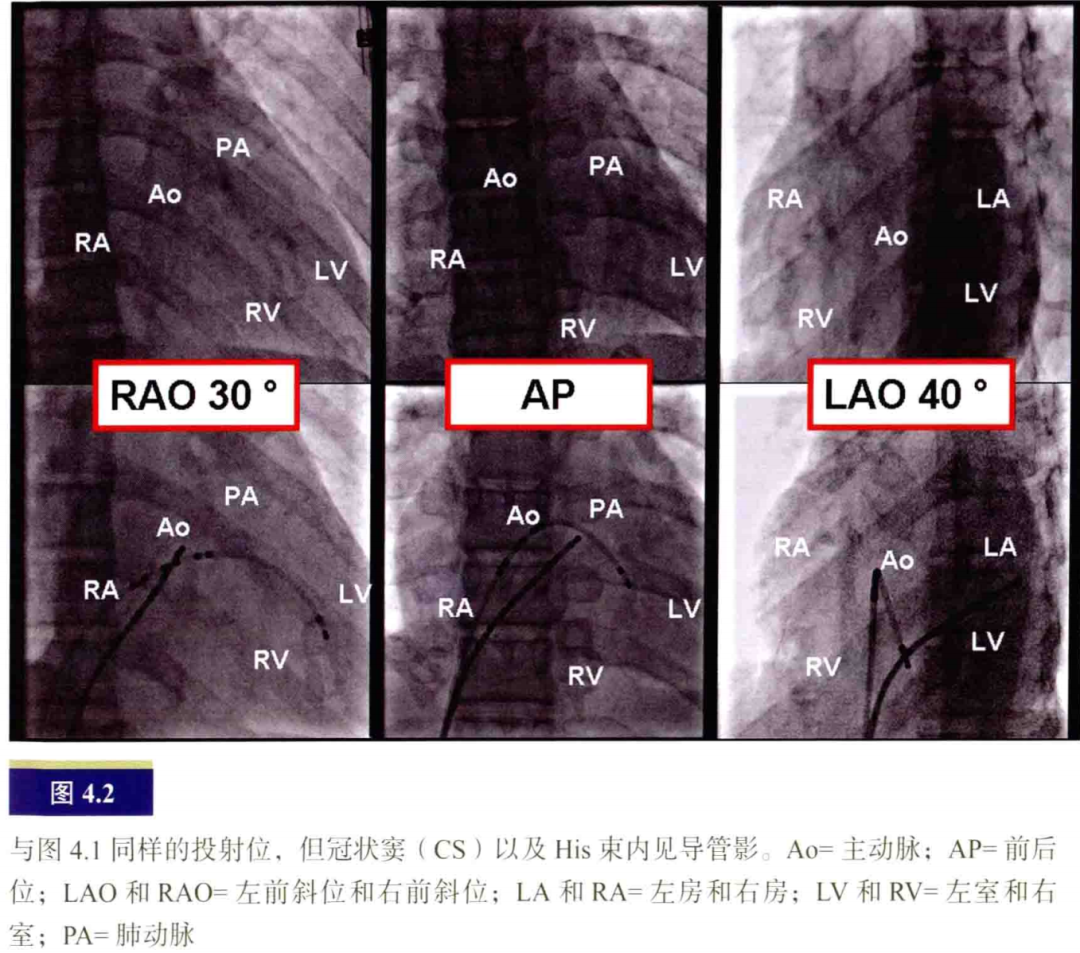 什么是电生理导管常规导管的放置：电生理和解剖_https://www.jmylbn.com_新闻资讯_第2张
