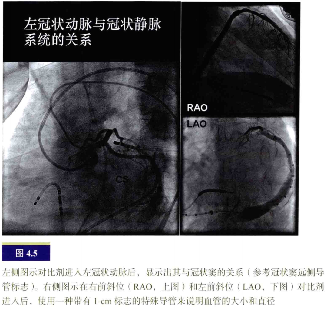 什么是电生理导管常规导管的放置：电生理和解剖_https://www.jmylbn.com_新闻资讯_第5张