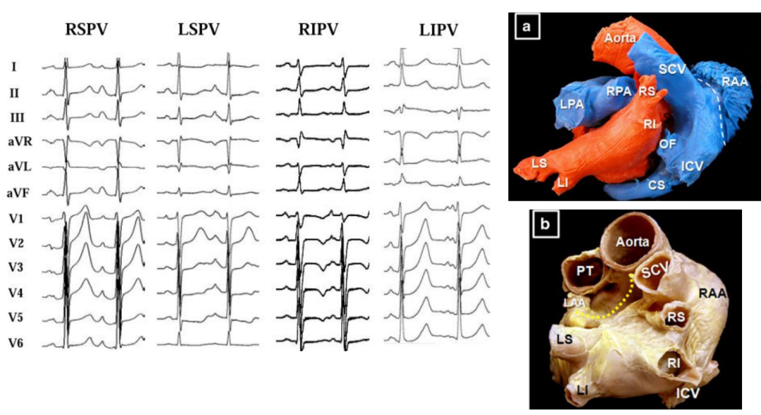 p心电图功能怎么开通异位起源P波的心电图定位_https://www.jmylbn.com_新闻资讯_第10张