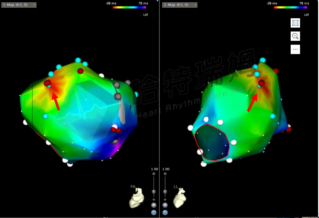 p心电图功能怎么开通异位起源P波的心电图定位_https://www.jmylbn.com_新闻资讯_第14张