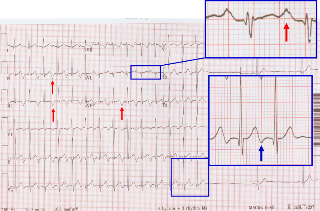 p心电图功能怎么开通异位起源P波的心电图定位_https://www.jmylbn.com_新闻资讯_第15张