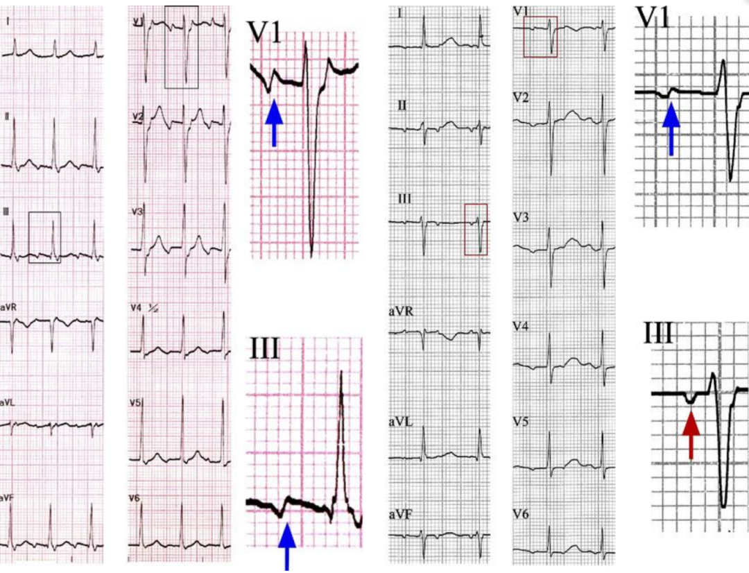 p心电图功能怎么开通异位起源P波的心电图定位_https://www.jmylbn.com_新闻资讯_第9张