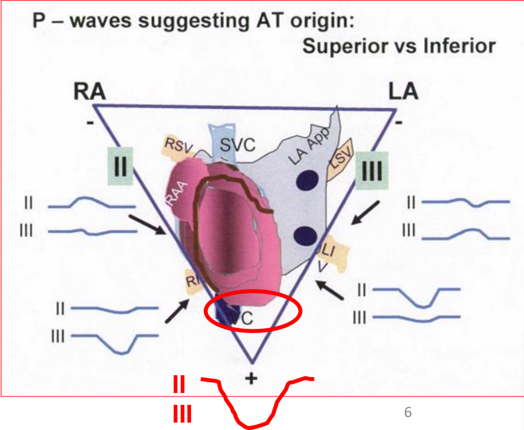 p心电图功能怎么开通异位起源P波的心电图定位_https://www.jmylbn.com_新闻资讯_第6张