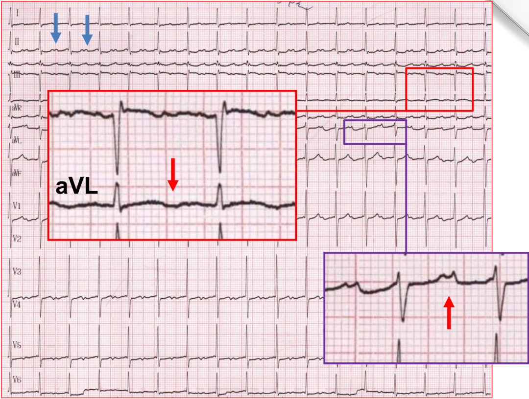 p心电图功能怎么开通异位起源P波的心电图定位_https://www.jmylbn.com_新闻资讯_第13张