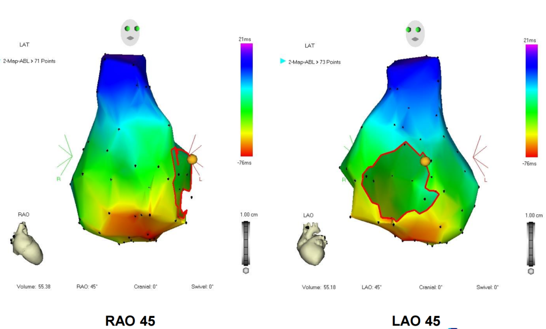 p心电图功能怎么开通异位起源P波的心电图定位_https://www.jmylbn.com_新闻资讯_第16张