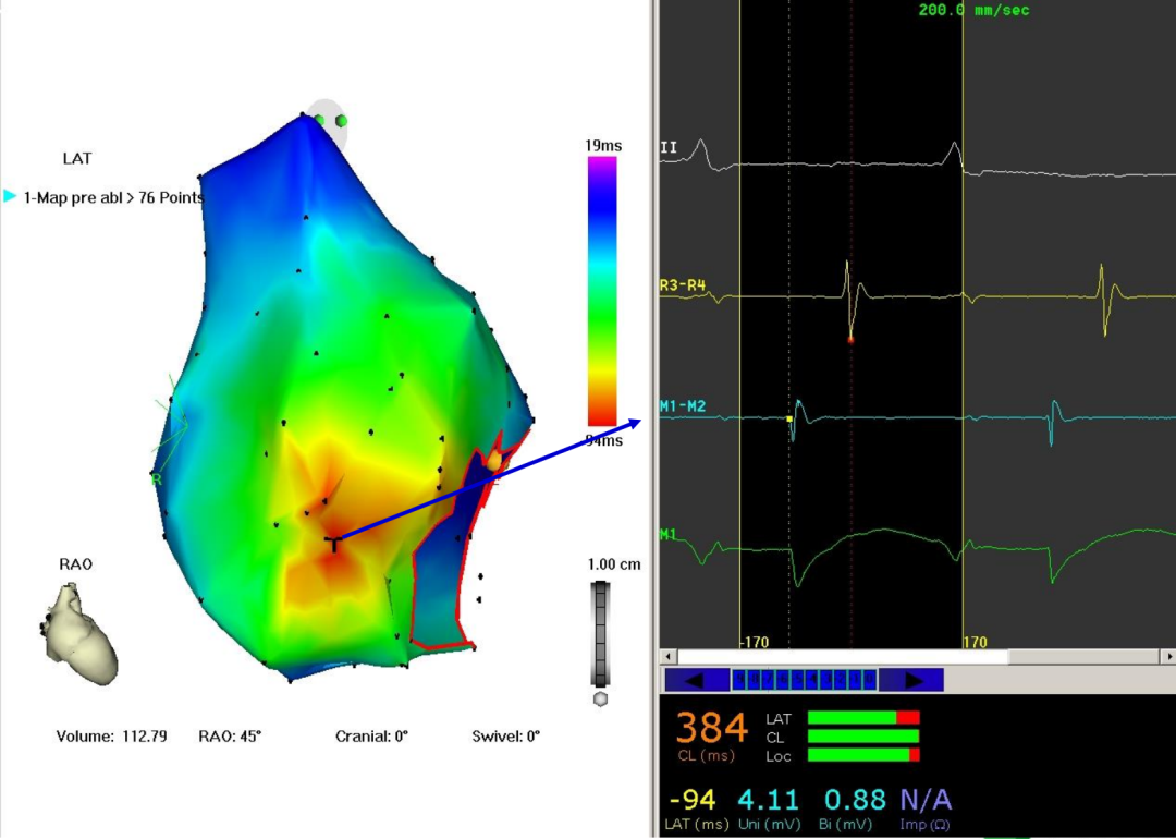 p心电图功能怎么开通异位起源P波的心电图定位_https://www.jmylbn.com_新闻资讯_第12张