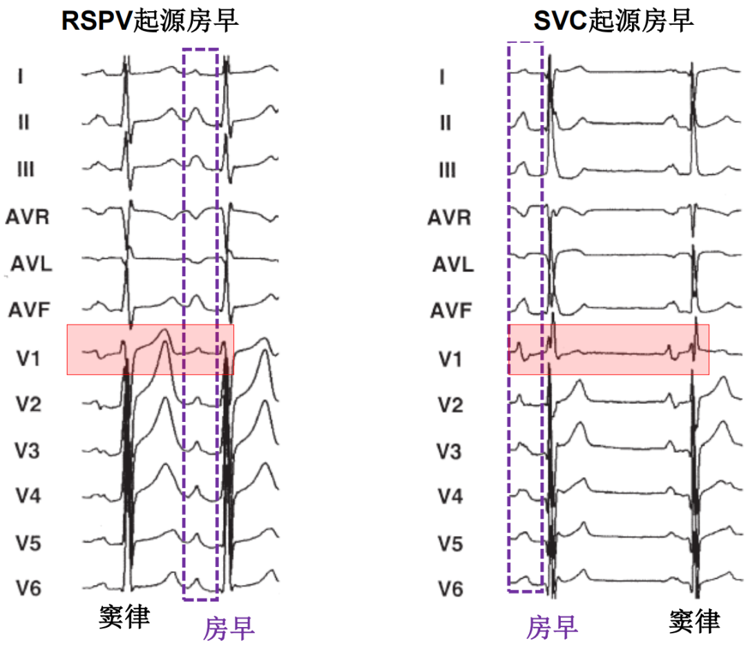 p心电图功能怎么开通异位起源P波的心电图定位_https://www.jmylbn.com_新闻资讯_第7张