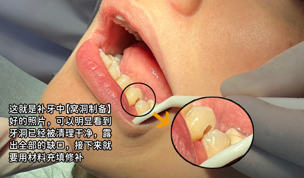 牙科材料硅胶怎么用如果你要做坏牙修复! 牙医告诉你怎么选材料和方案_https://www.jmylbn.com_新闻资讯_第6张