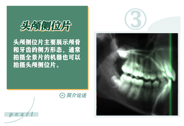 X光拍片为什么要等看牙为什么要拍片？非专业人士如何看懂自己的牙片！_https://www.jmylbn.com_新闻资讯_第6张