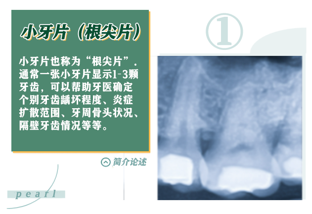 X光拍片为什么要等看牙为什么要拍片？非专业人士如何看懂自己的牙片！_https://www.jmylbn.com_新闻资讯_第4张