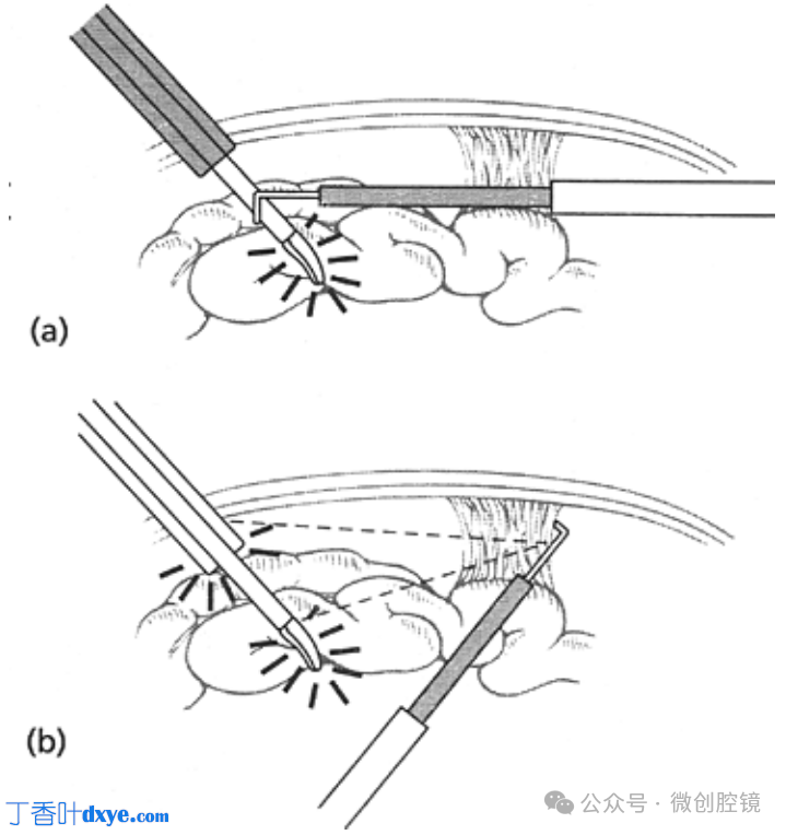 双极电凝是什么腹腔镜电凝技巧_https://www.jmylbn.com_新闻资讯_第8张