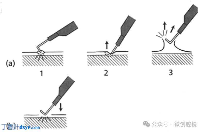双极电凝是什么腹腔镜电凝技巧_https://www.jmylbn.com_新闻资讯_第5张