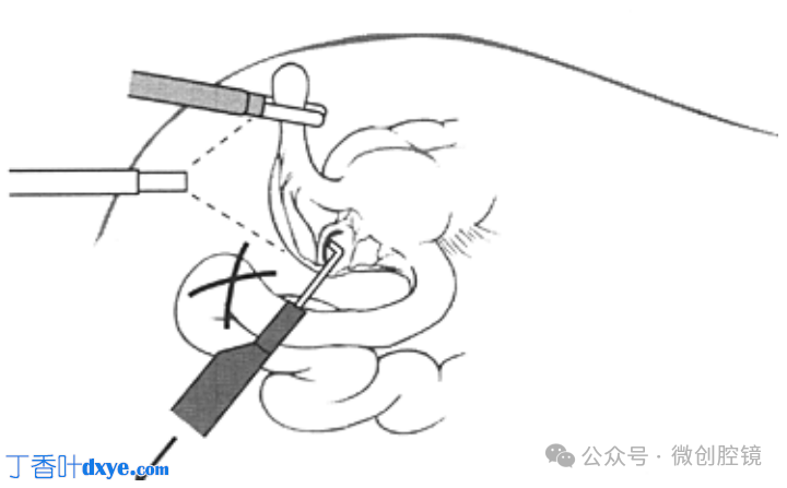 双极电凝是什么腹腔镜电凝技巧_https://www.jmylbn.com_新闻资讯_第6张