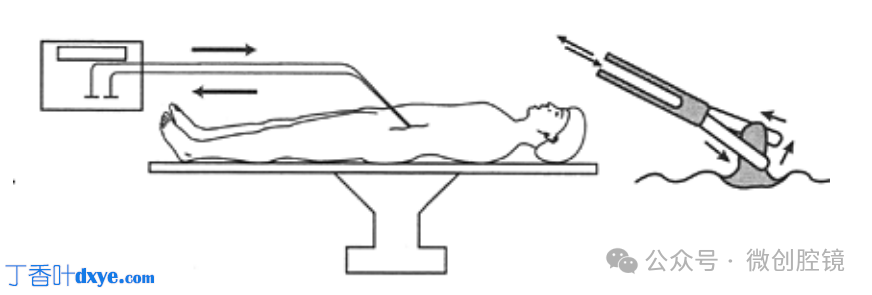 双极电凝是什么腹腔镜电凝技巧_https://www.jmylbn.com_新闻资讯_第2张