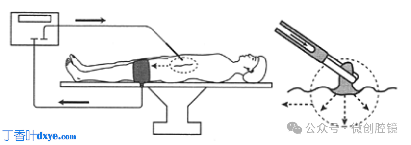 双极电凝是什么腹腔镜电凝技巧_https://www.jmylbn.com_新闻资讯_第1张