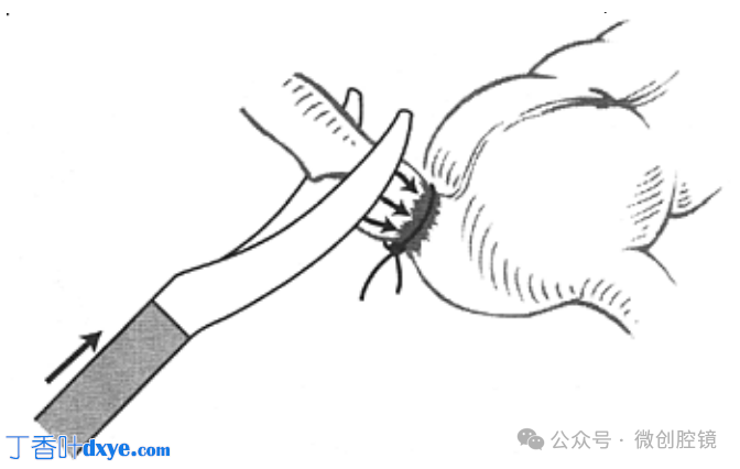 双极电凝是什么腹腔镜电凝技巧_https://www.jmylbn.com_新闻资讯_第7张