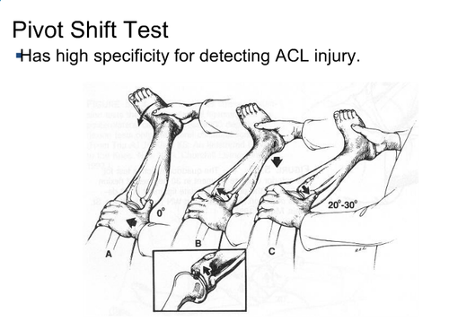 医学上ACL是什么超详细前交叉韧带(ACL)损伤断裂评估，新杠杆征测试，实用！_https://www.jmylbn.com_新闻资讯_第4张