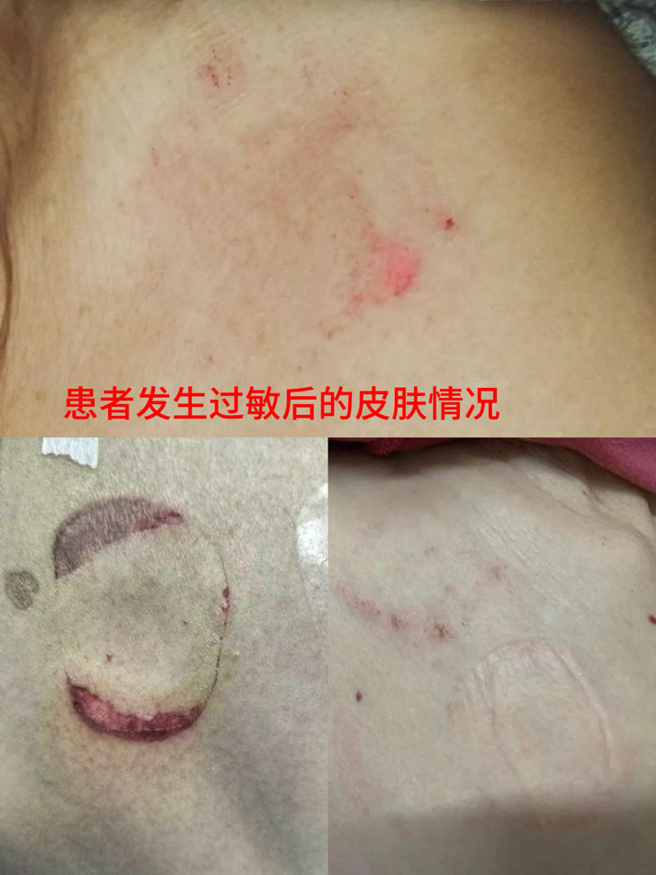 怎么撕敷料啊只需准备一张水胶体敷料，撕电极片不担心皮损了！_https://www.jmylbn.com_新闻资讯_第3张