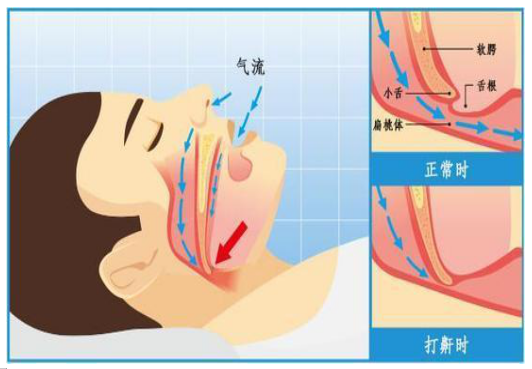 为什么要用湿化器家庭氧疗之家用呼吸机的那些事儿_https://www.jmylbn.com_新闻资讯_第4张