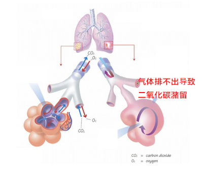 为什么要用湿化器家庭氧疗之家用呼吸机的那些事儿_https://www.jmylbn.com_新闻资讯_第3张