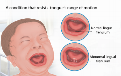 孩子說話晚、發音不清是因為舌系帶過短？手術割一下有必要嗎？ 親子 第4張
