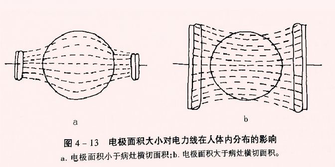 为什么理疗用电极刺激康复理疗指南 ｜ 低、中、高频电疗法精准化参数、电极放置和风险防范指南_https://www.jmylbn.com_新闻资讯_第6张