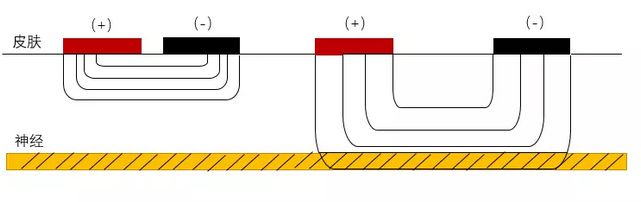 为什么理疗用电极刺激康复理疗指南 ｜ 低、中、高频电疗法精准化参数、电极放置和风险防范指南_https://www.jmylbn.com_新闻资讯_第15张