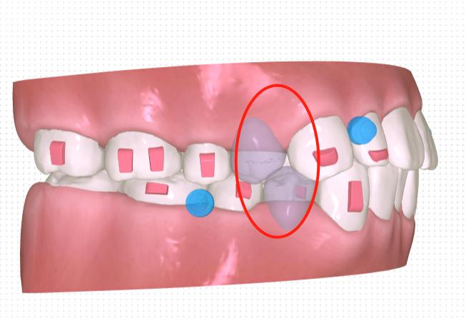 牙科材料硅胶怎么用隐形矫正中，咬胶如何正确使用_https://www.jmylbn.com_新闻资讯_第17张