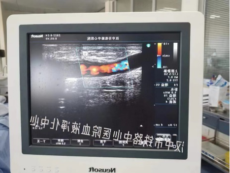 活检钳怎么用医技丨微创引领血管通路新时代，活检钳在自体动静脉内瘘血栓形成中的应用_https://www.jmylbn.com_新闻资讯_第12张