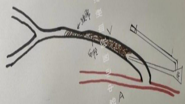 活检钳怎么用医技丨微创引领血管通路新时代，活检钳在自体动静脉内瘘血栓形成中的应用_https://www.jmylbn.com_新闻资讯_第9张