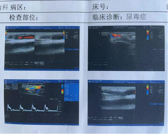 活检钳怎么用医技丨微创引领血管通路新时代，活检钳在自体动静脉内瘘血栓形成中的应用_https://www.jmylbn.com_新闻资讯_第7张