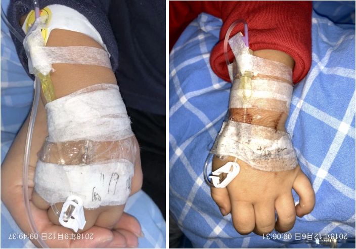 普通留置针怎么固定小儿留置针容易滑脱，这样固定安全又有爱！_https://www.jmylbn.com_新闻资讯_第4张