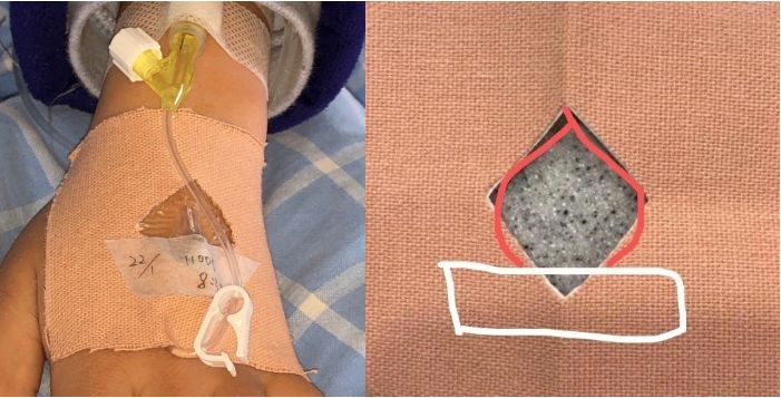 普通留置针怎么固定小儿留置针容易滑脱，这样固定安全又有爱！_https://www.jmylbn.com_新闻资讯_第6张