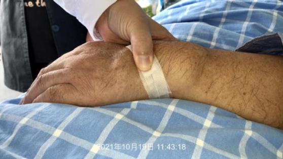 刚接班手背就肿成馒头样?