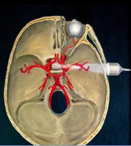 TCD怎么切换探头TCD：经颅多普勒(1-2)：基础知识、检查操作_https://www.jmylbn.com_新闻资讯_第2张