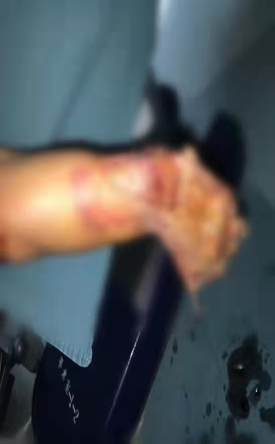 为什么负压引流再谈负压封闭引流技术_https://www.jmylbn.com_新闻资讯_第2张